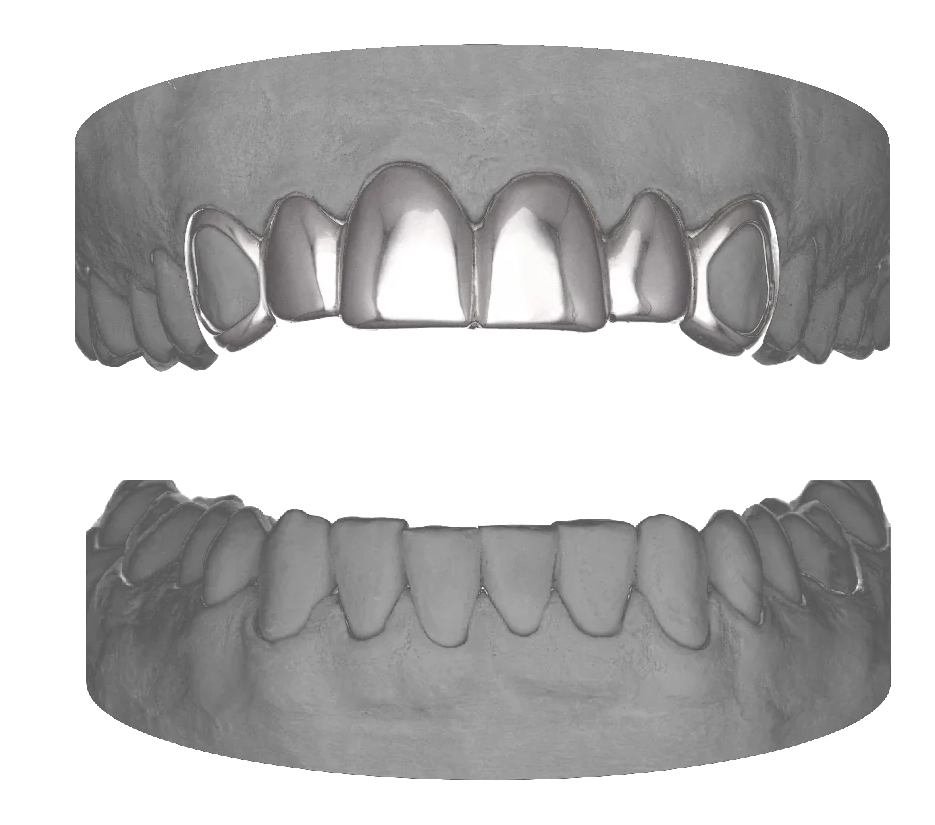 6 Set With Window Canines Upper